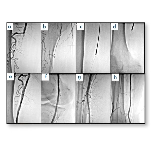 aterectomia rotacional periferica temren 6 biogen